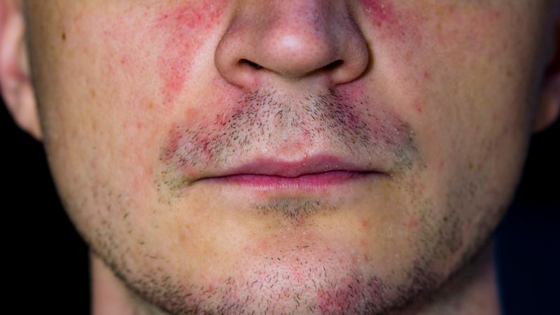 dermatitis nickel allergy after shaving